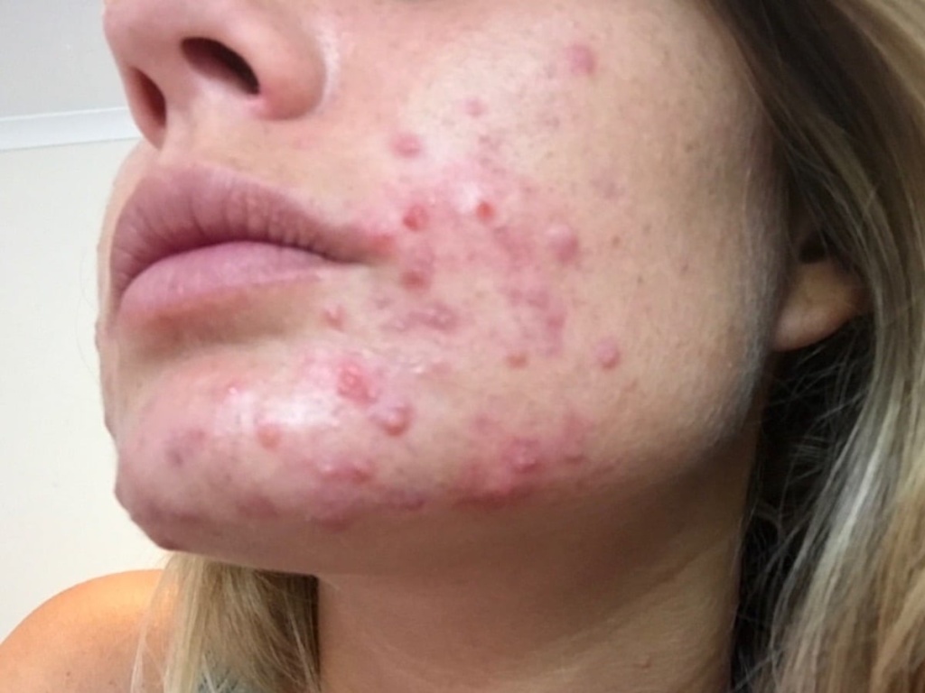 Cystic Acne Before