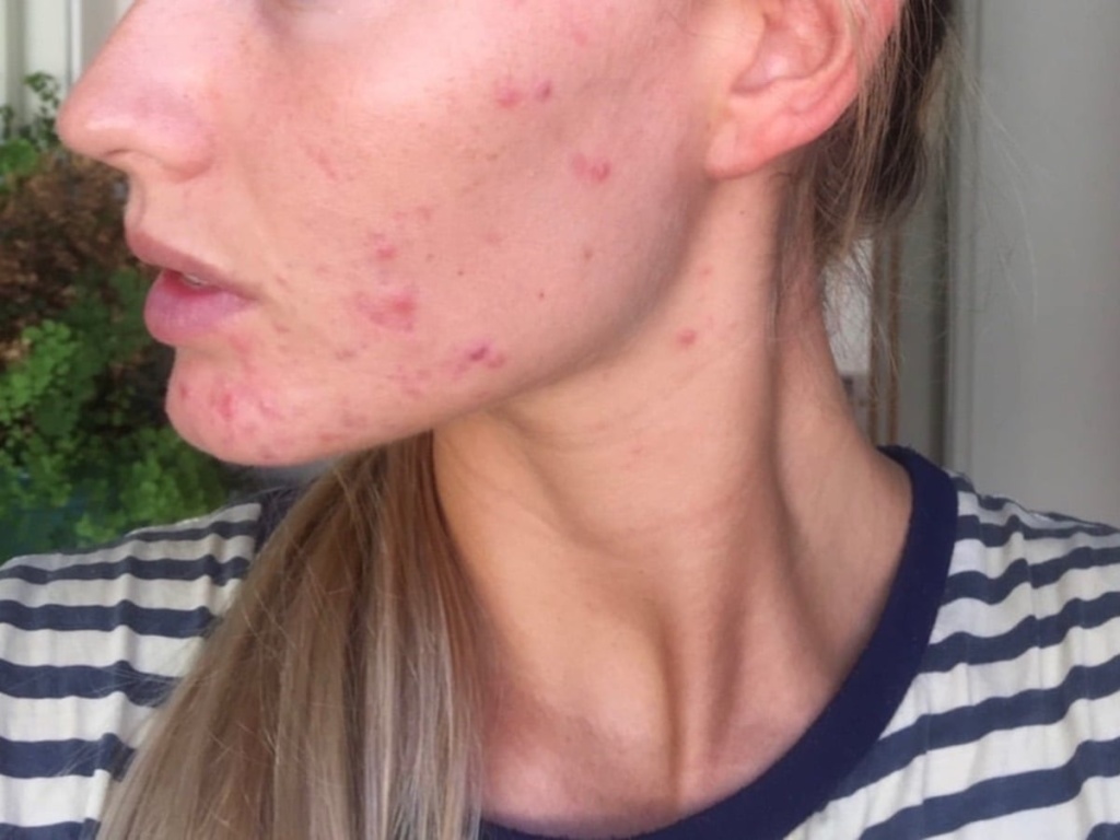 Cystic Acne Midway