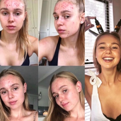 Cystic Acne Relief With Cannabella (1)