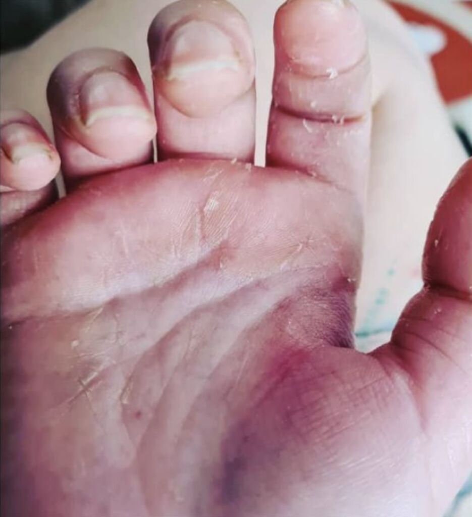 Dry Skin Relief With Hemp Jelly After 935x1024