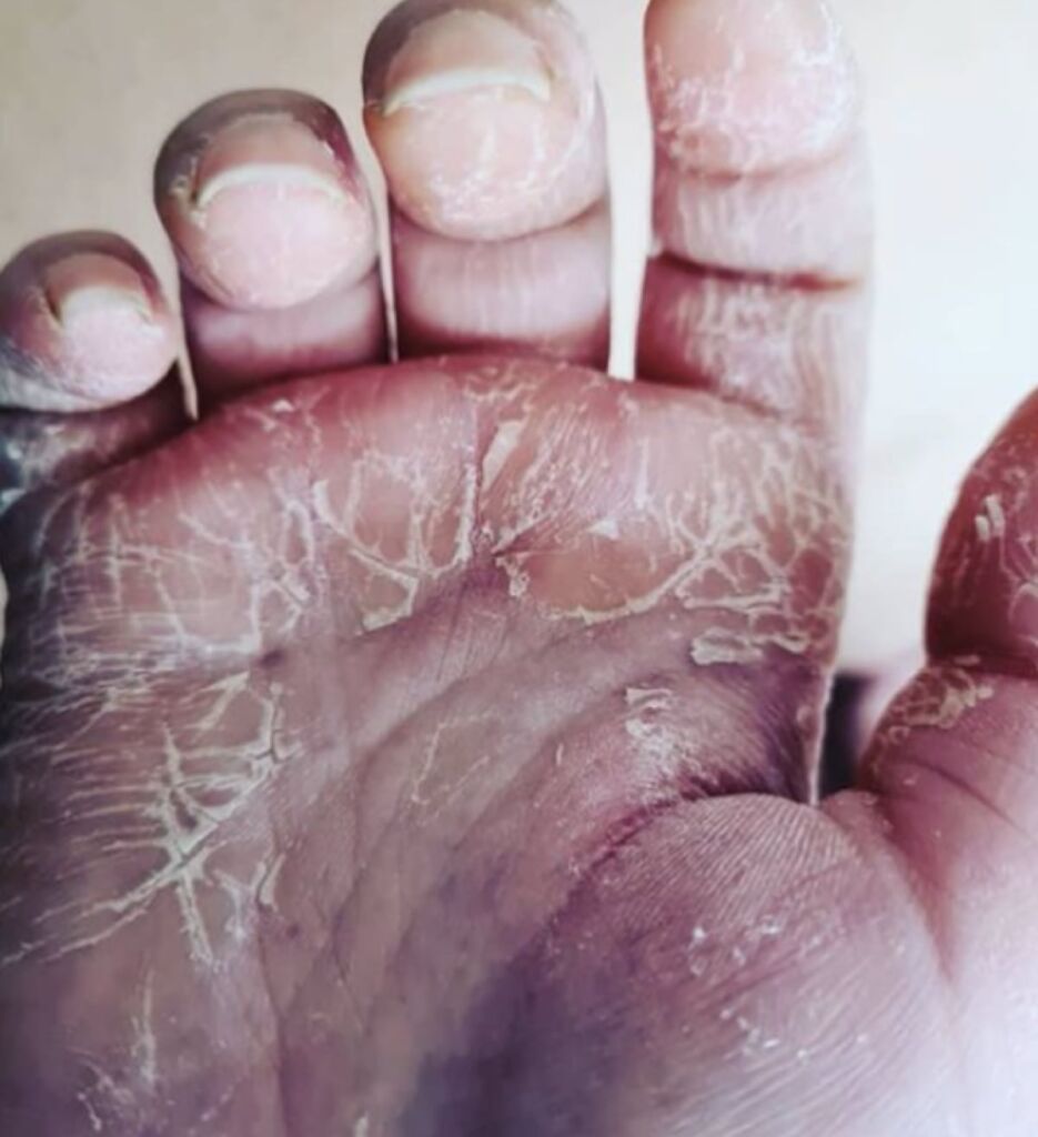 Dry Skin Relief With Hemp Jelly Before 935x1024